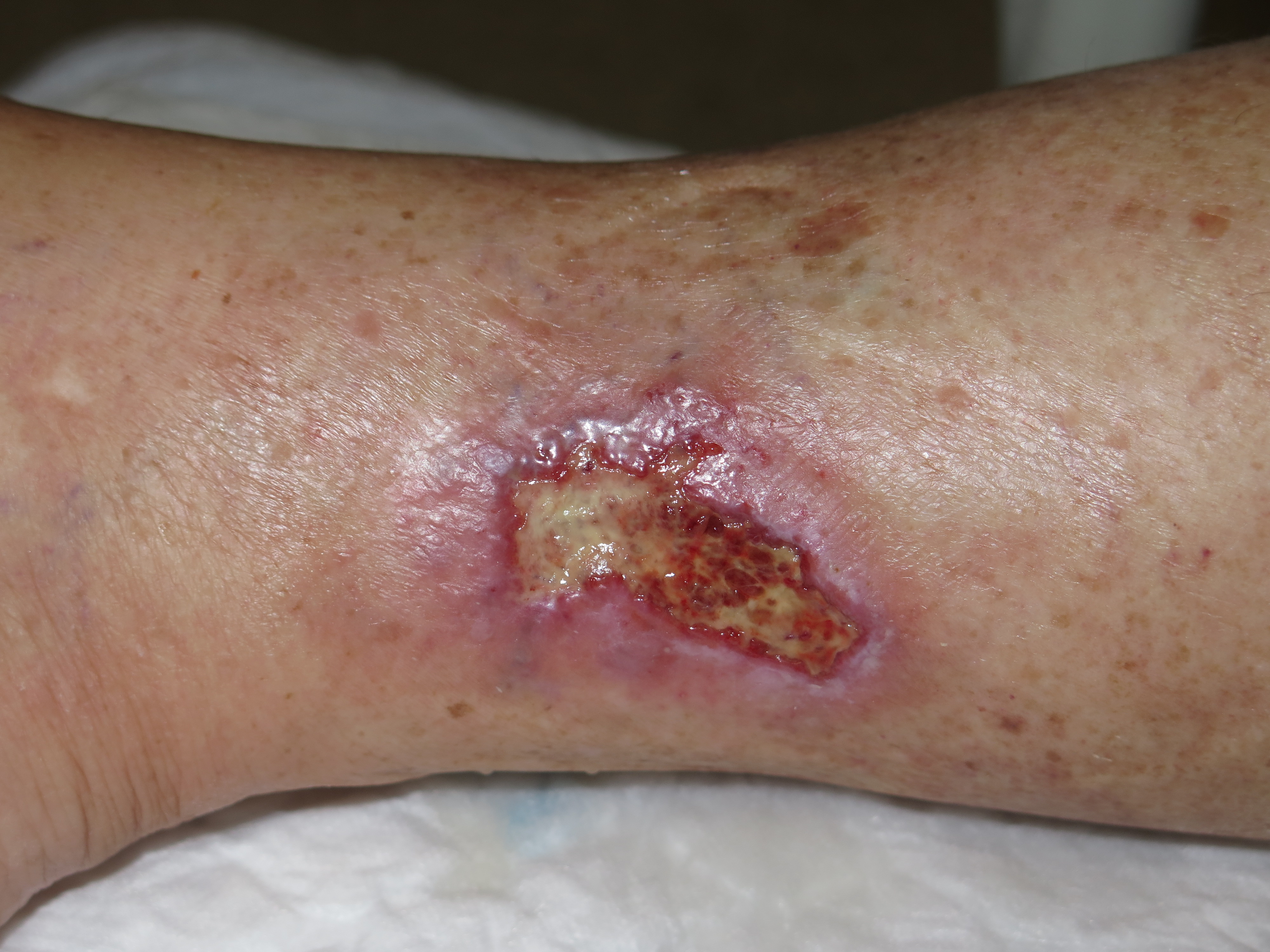 úlcera martorell 2