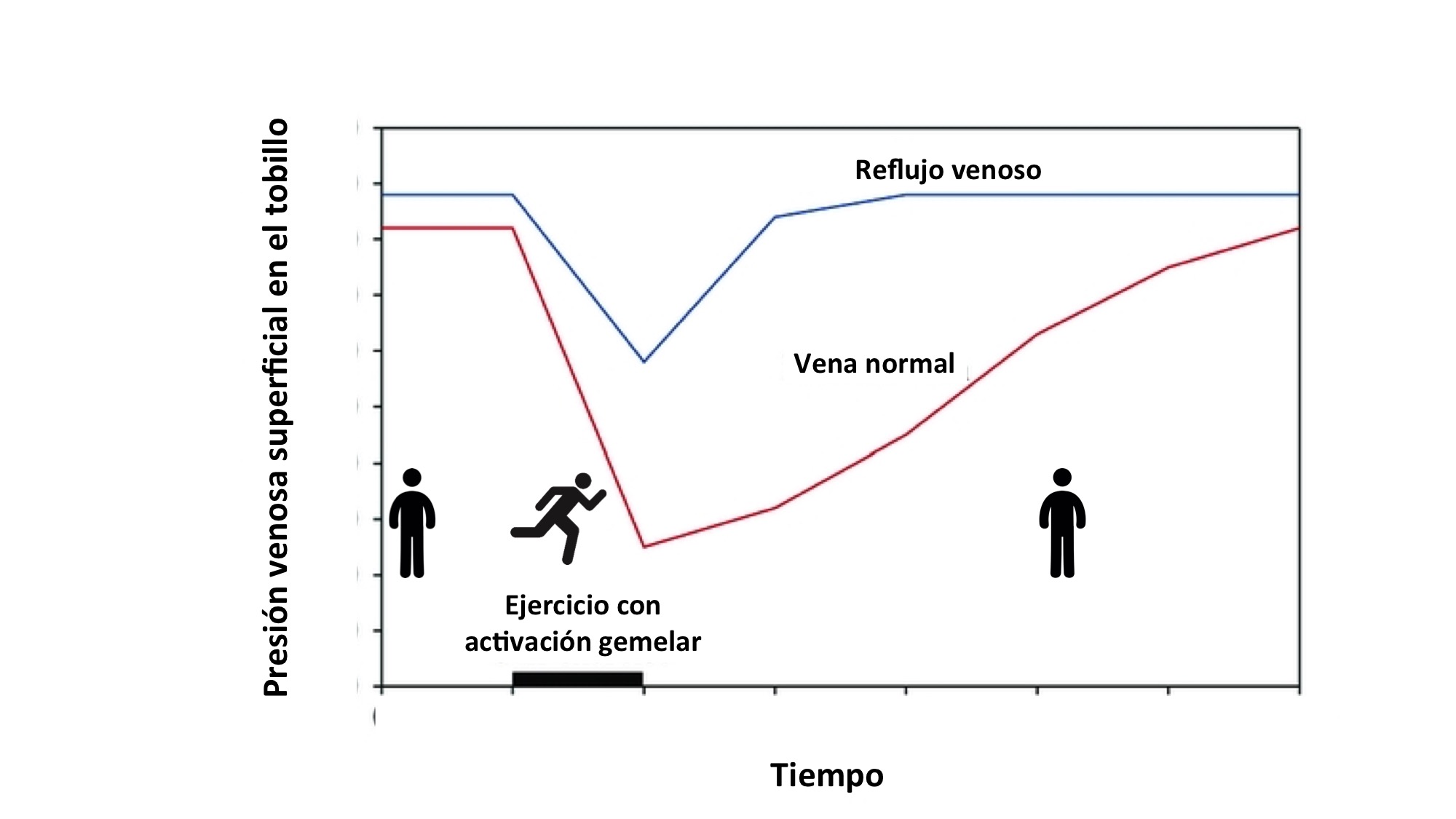 Esquema presión venosa durante el ejercicio (vena normal vs reflujo venoso)