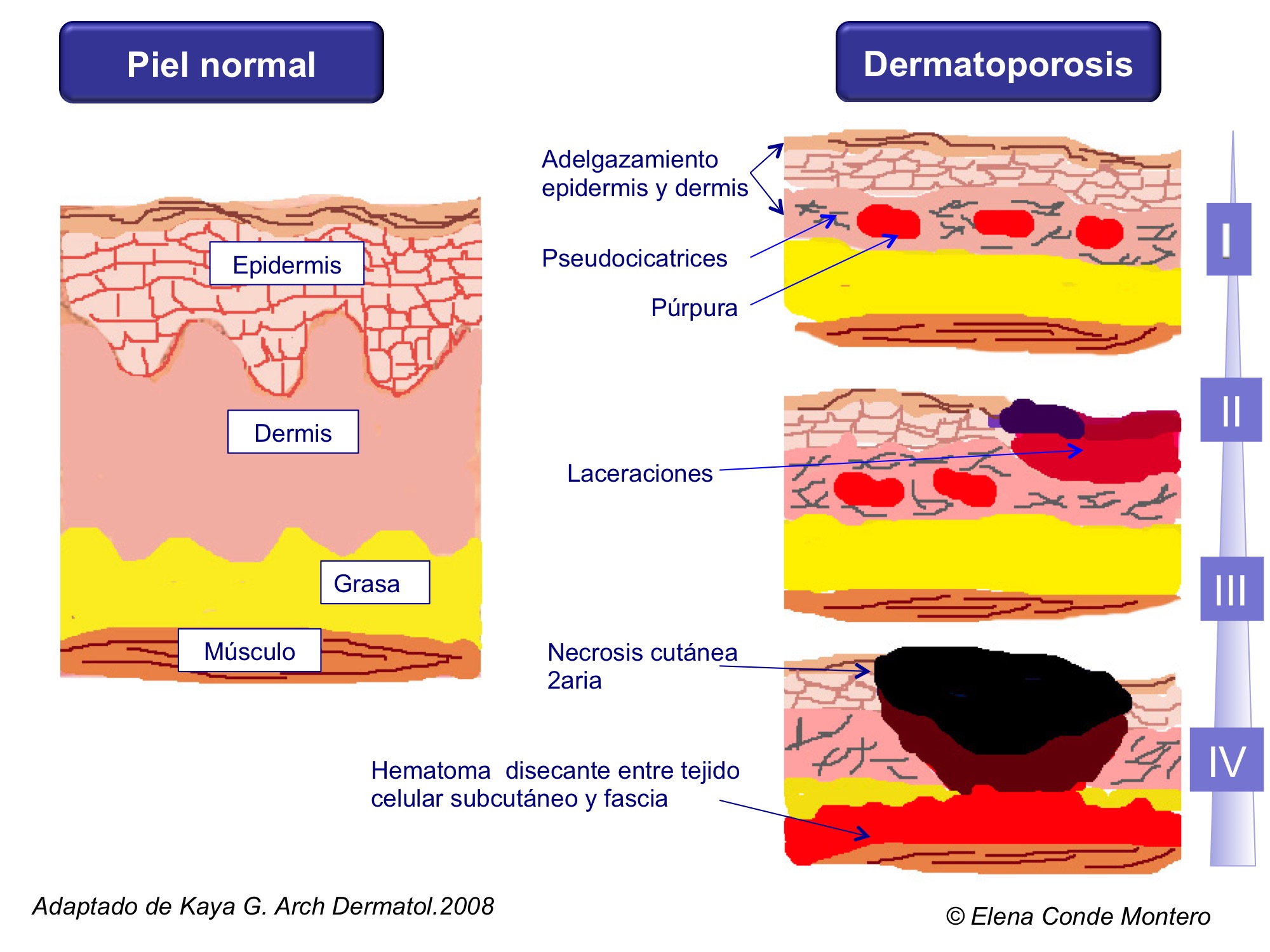 Grados de afectación de la dermatoporosis