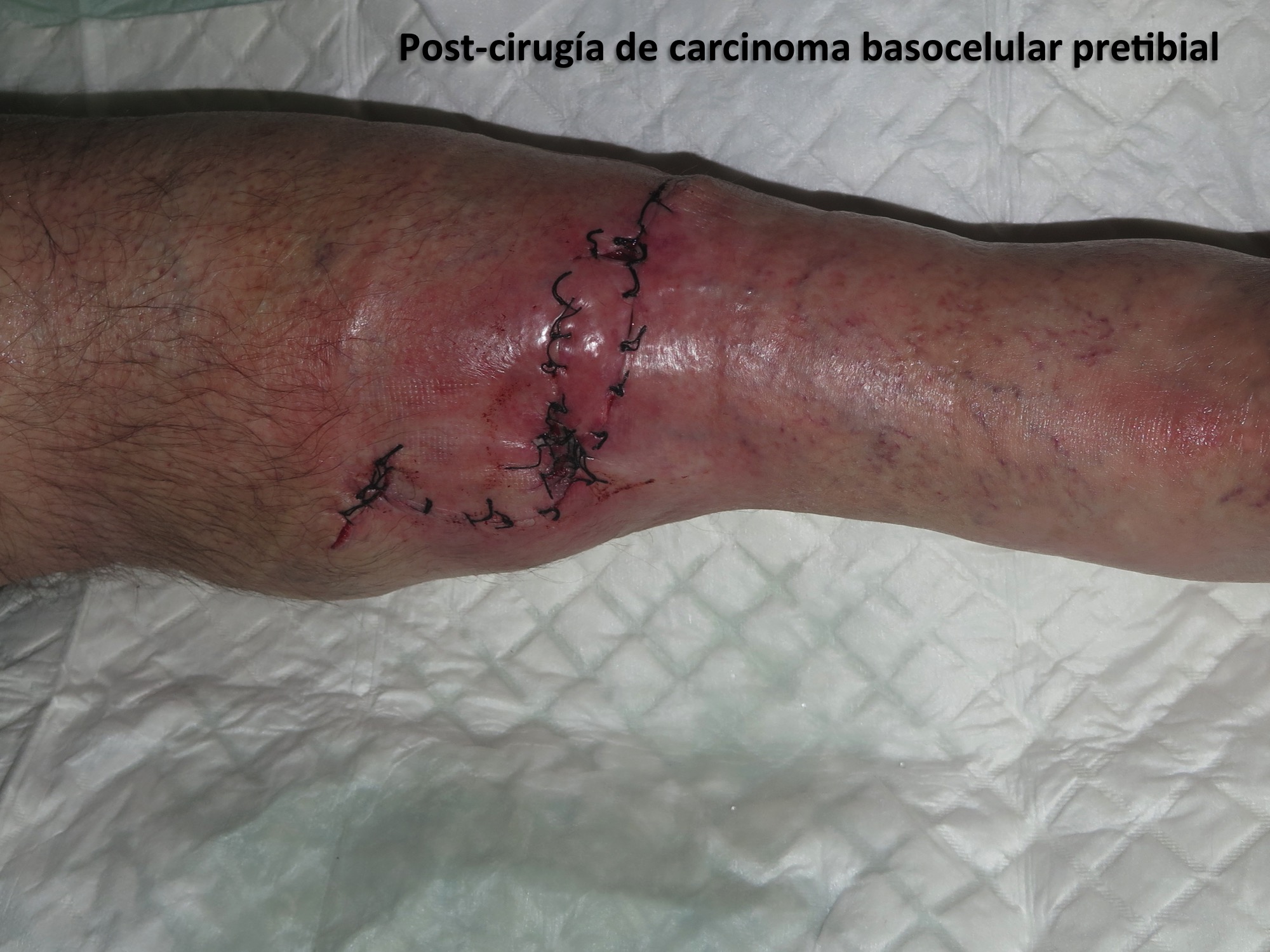 Post-cirugía de carcinoma basocelular pretibial