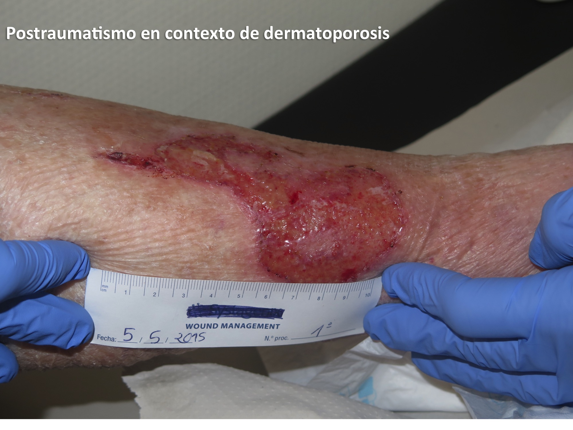 Postraumatismo en contexto de dermatoporosis