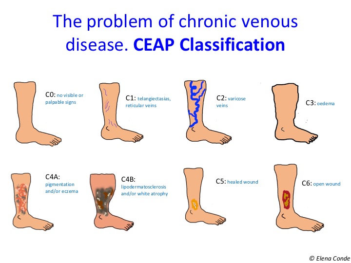 venous stasis symptoms and signs