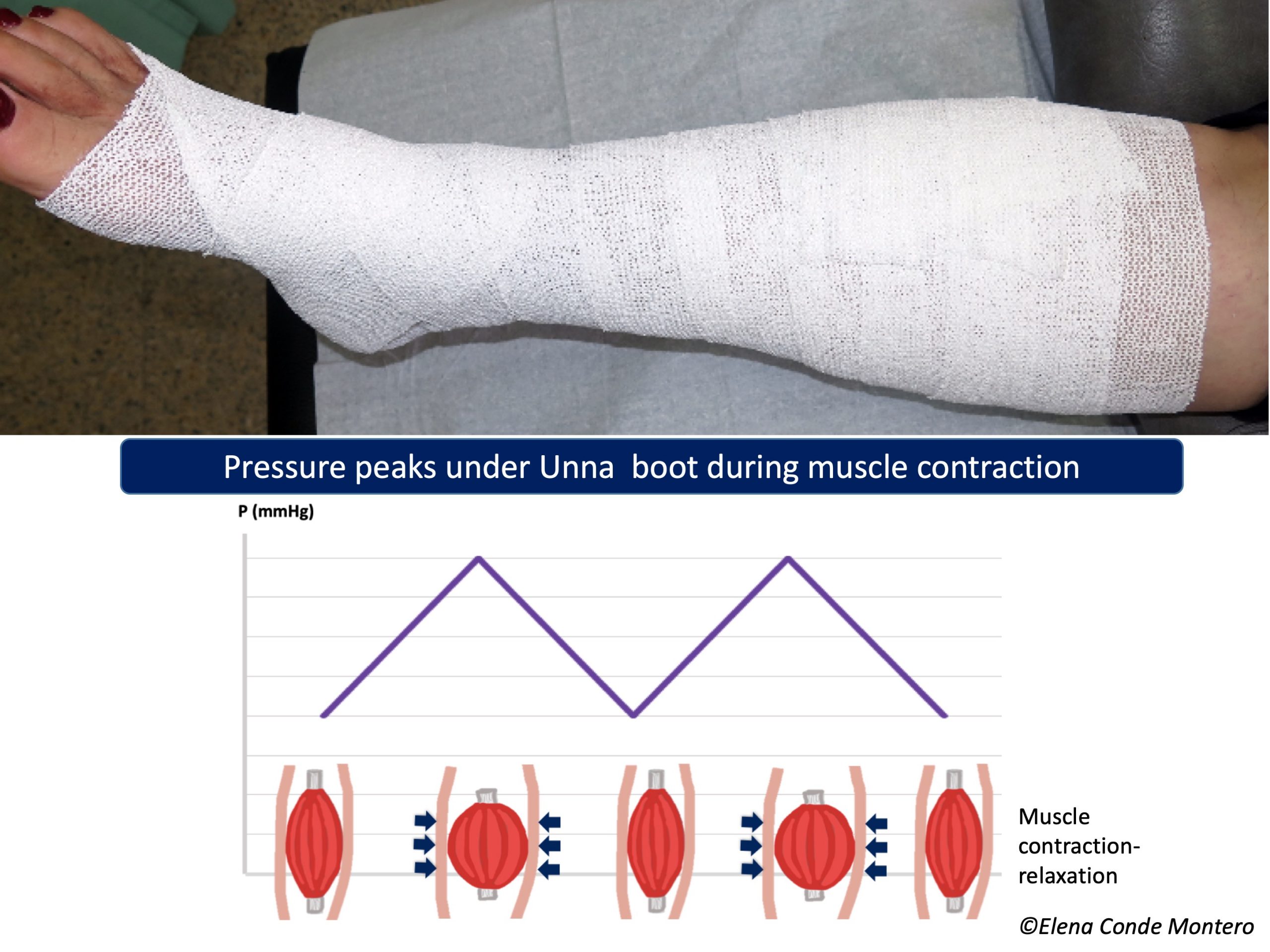 Unna Flex Elastic Unna Boot Bandage — Mountainside Medical Equipment