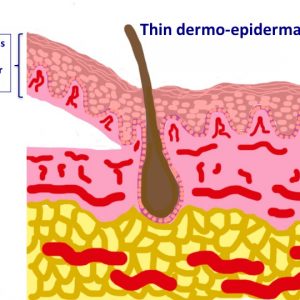 thin dermo-epidermal graft
