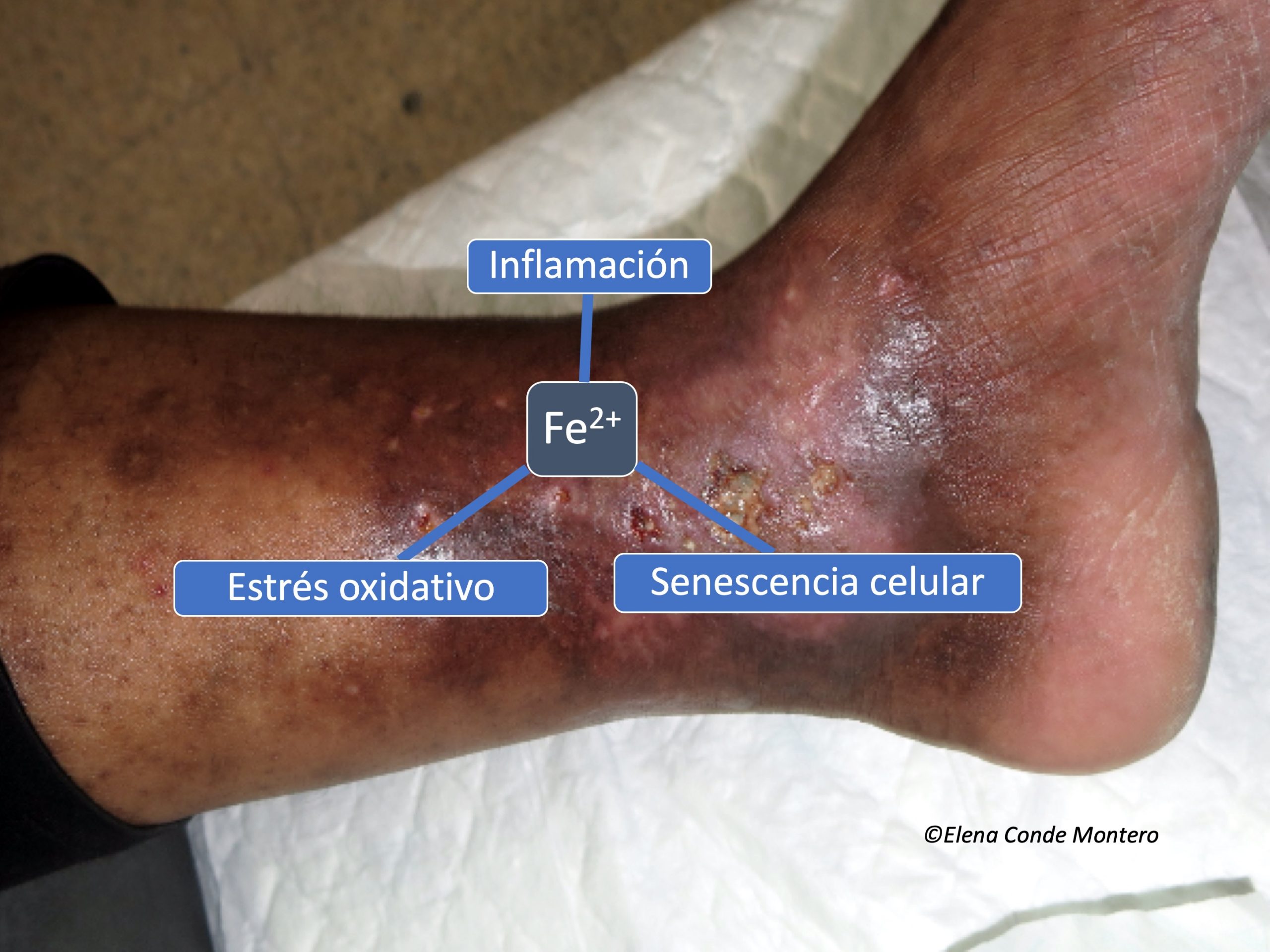 Varicoză și eczemă pe picioare, Dermatita de staza: complicatii, factori de risc, diagnostic