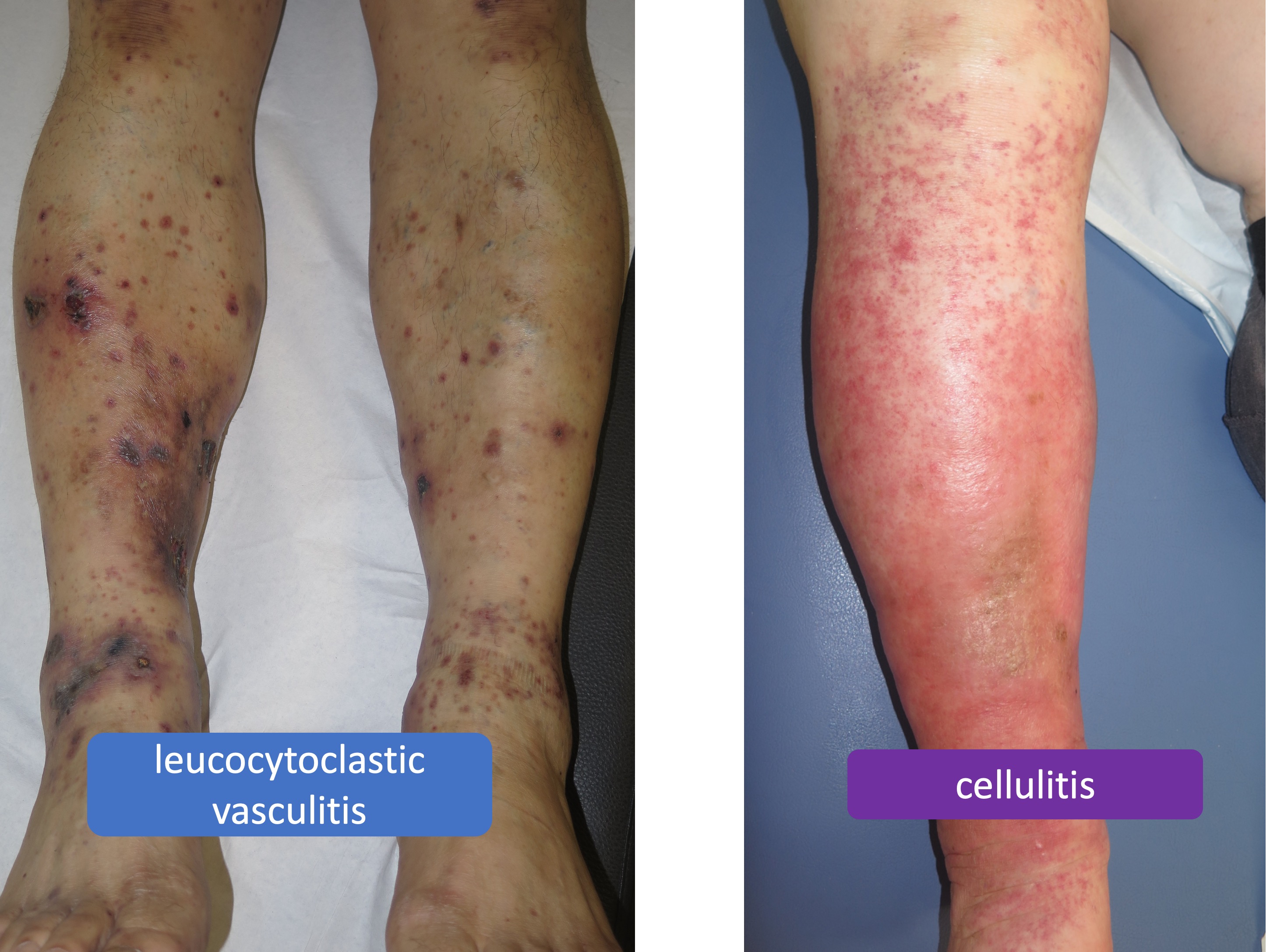 https://www.elenaconde.com/wp-content/uploads/2020/03/vasculitis-cellulitis.jpg