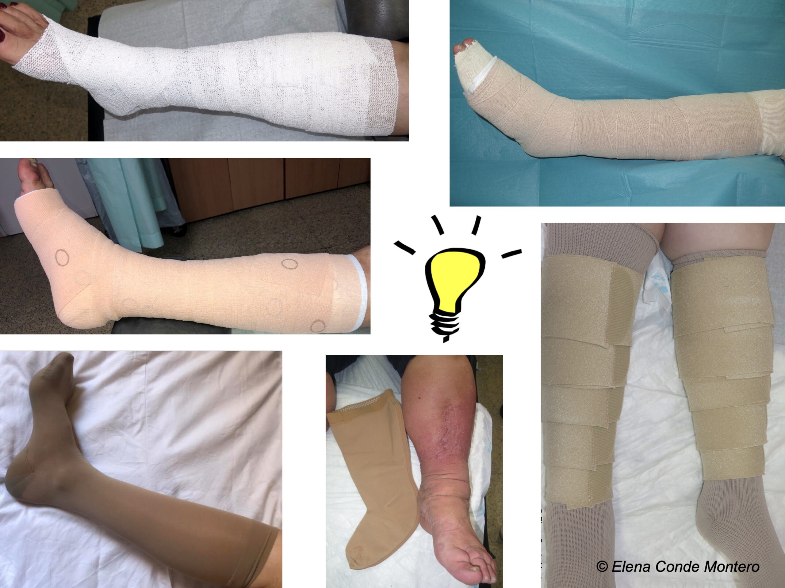 What type of compression therapy to choose in each situation?