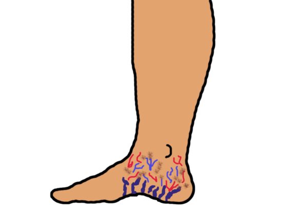 Phlebectatica Corona phlebectatica: sign of advanced chronic venous insufficiency ...